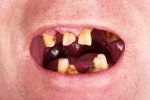 oral-cancer-tooth-decay.jpg