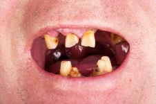 oral-cancer-tooth-decay.webp